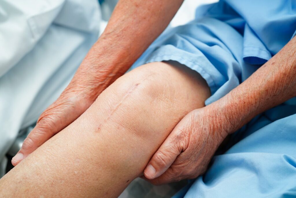Elderly patient recovering from knee replacement surgery needing physiotherapy to regain mobility